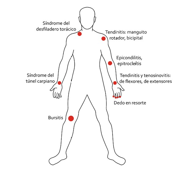 Localización de algunos TME que afectan a las extremidades corporales